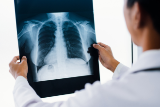 Descubra com a Dra. Thaline Neves Coutinho como a tomografia é essencial para identificar doenças pulmonares com precisão e segurança.